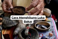 Cara Menghitung Luka Bakar